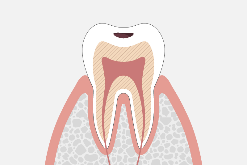 エナメル質内のむし歯