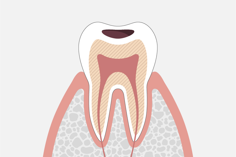 象牙質に達したむし歯