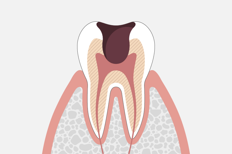 歯髄(神経)に達したむし歯