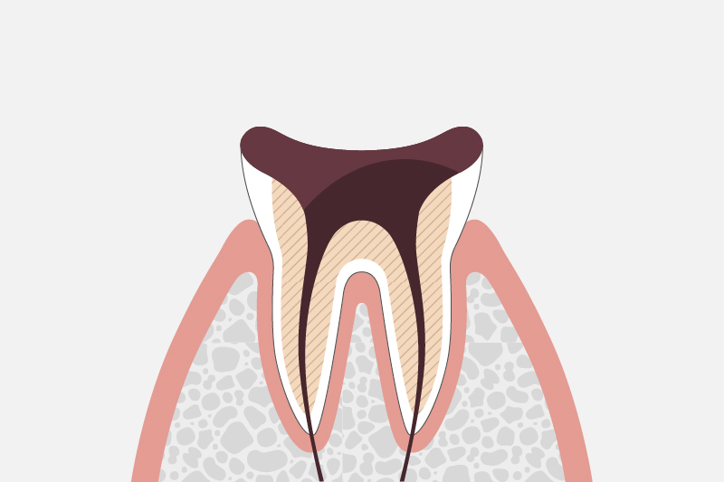 歯の神経が残っていない場合の治療方法