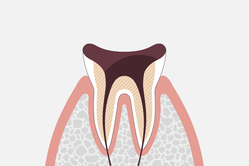 歯質が失われたむし歯