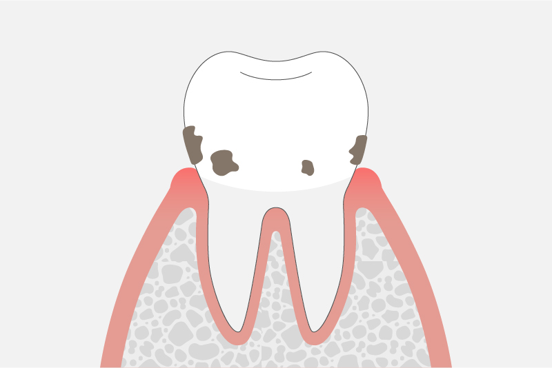 軽度歯周病